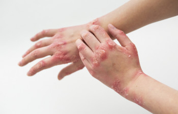 Mali vodič kroz psorijazu: zašto nastaje i kako se liječi
