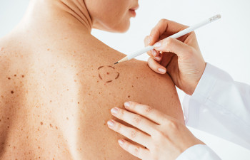 Borba za podizanje svijesti o melanomu: O koži moramo brinuti stalno